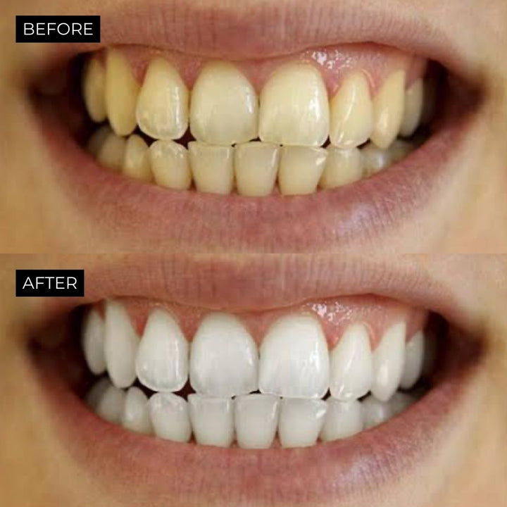 Ultimate Teeth Whitening Kit